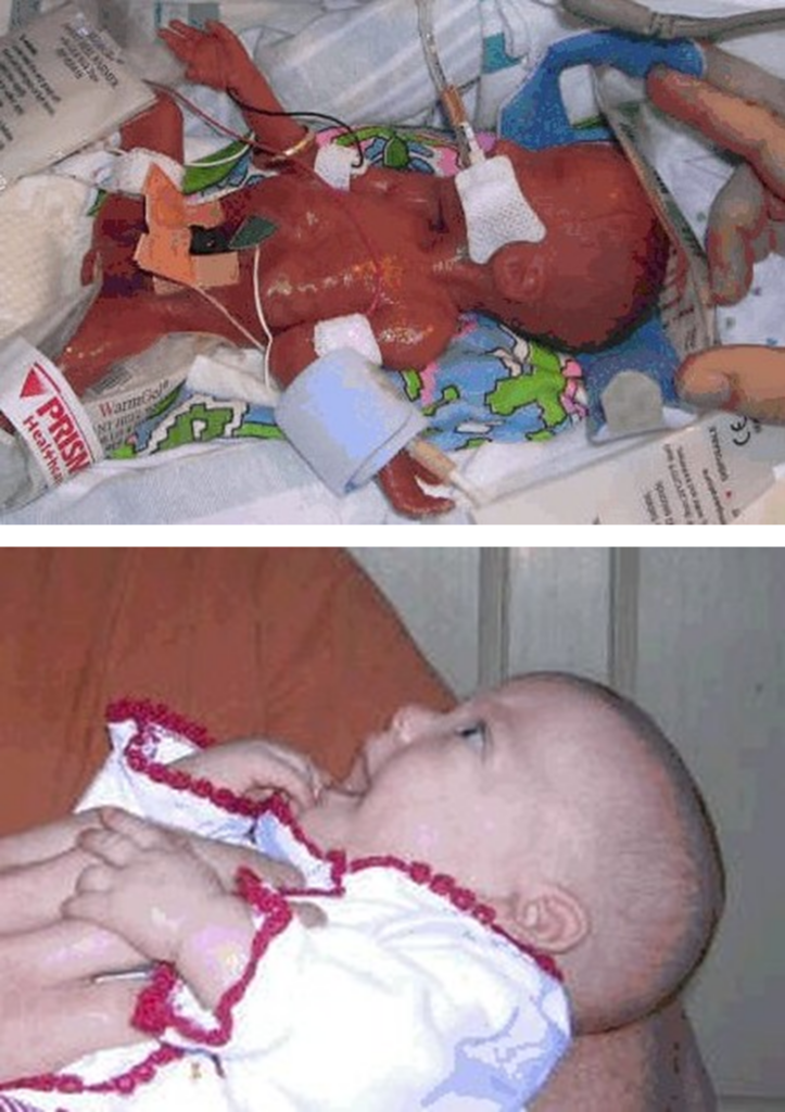 Premature baby at birth in NICU and healthy at 6 months